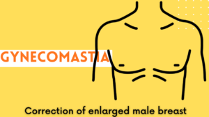 gynecomastia surgery best surgeon doctor near me in india ranchi patna kolkata