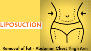 Best tummy tuck abdominoplasty Liposuction Plastic Surgeon near me