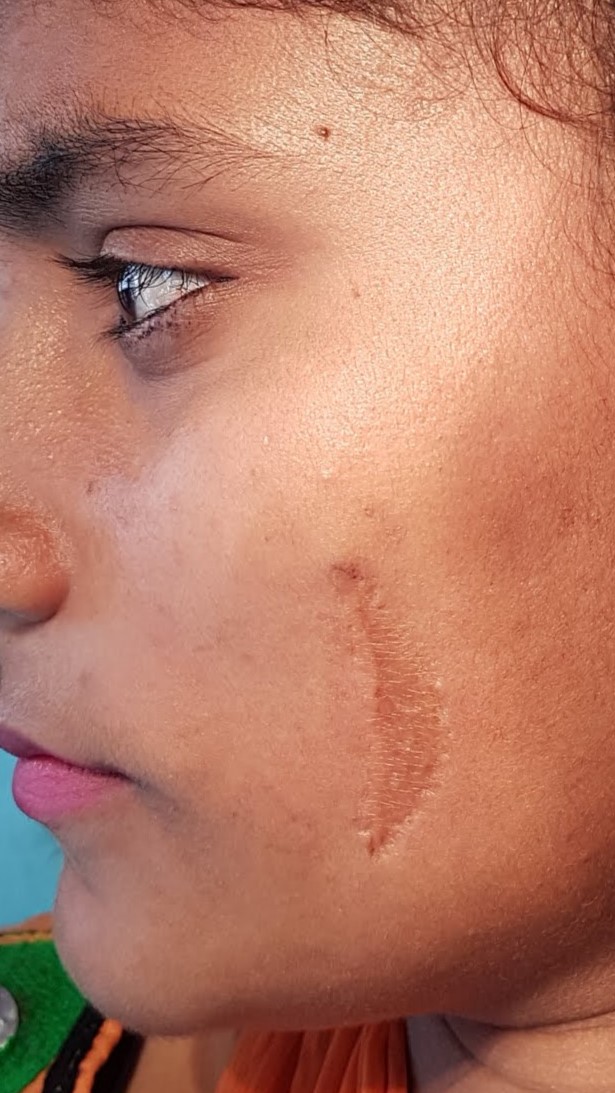 face scar revision surgery