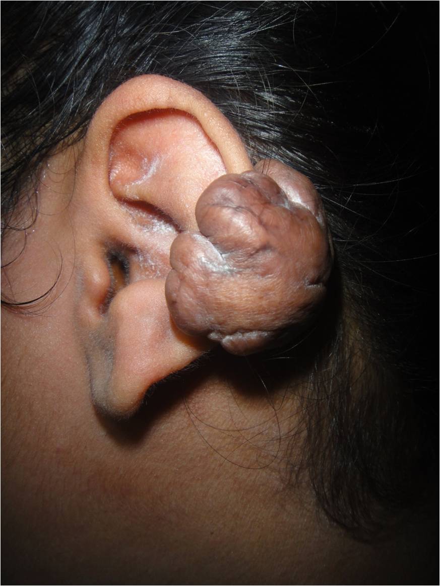 ear keloid surgery