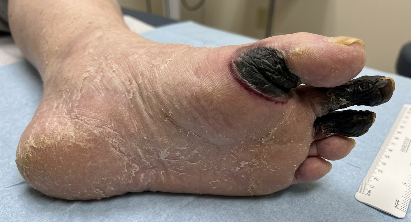 diabetic foot